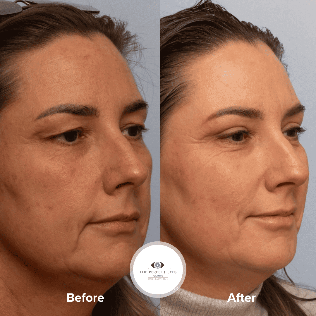 Before and after Upper Blepharoplasty, a patient of Dr Sabrina Shah-Desai