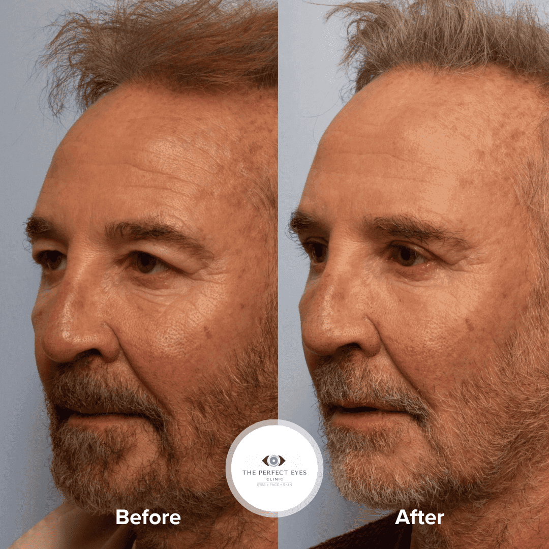 Before and after Ptosis Surgery, a patient of Dr Sabrina Shah-Desai