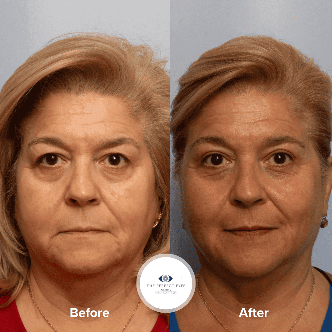 Upper blepharoplasty before and after, case 13, by Dr Sabrina Shah-Desai
