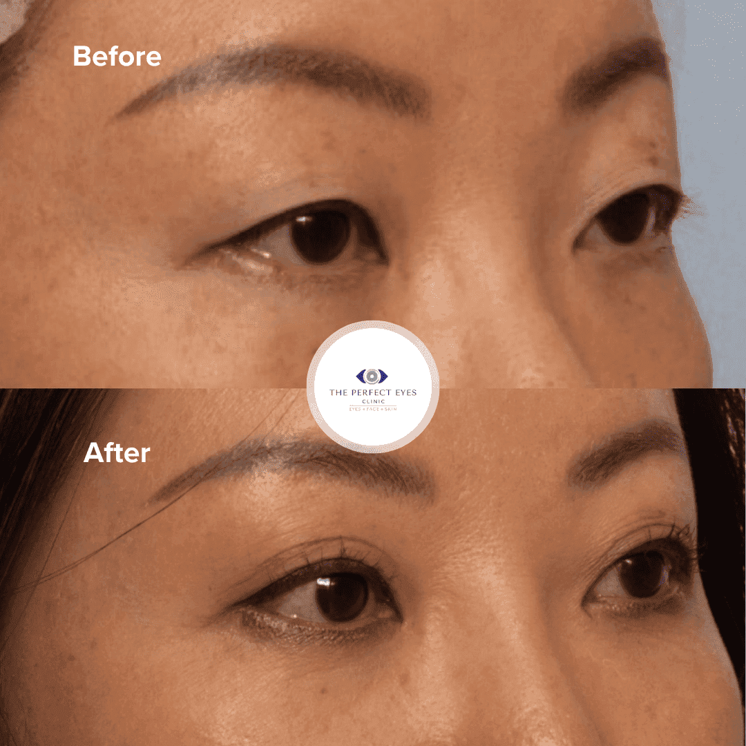 Monolids and Double Eyelid Surgery before and after, a patient of Dr Sabrina Shah-Desai
