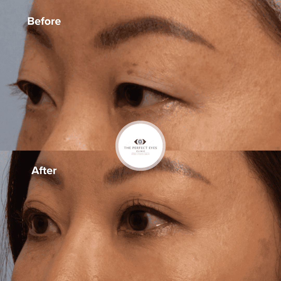Asian blepharoplasty before and after, case 10, by Dr Sabrina Shah-Desai