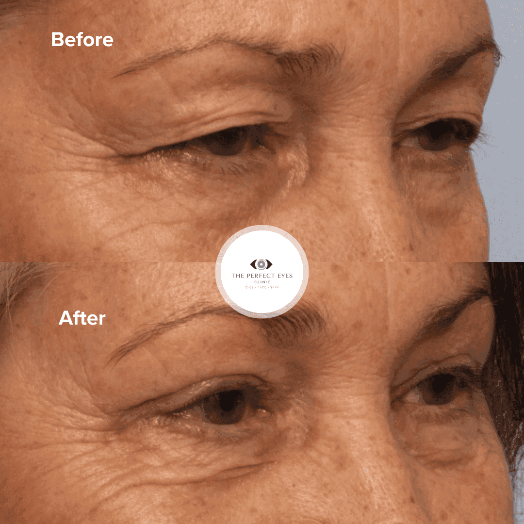 Ptosis surgery before and after, case 19, by Dr Sabrina Shah-Desai