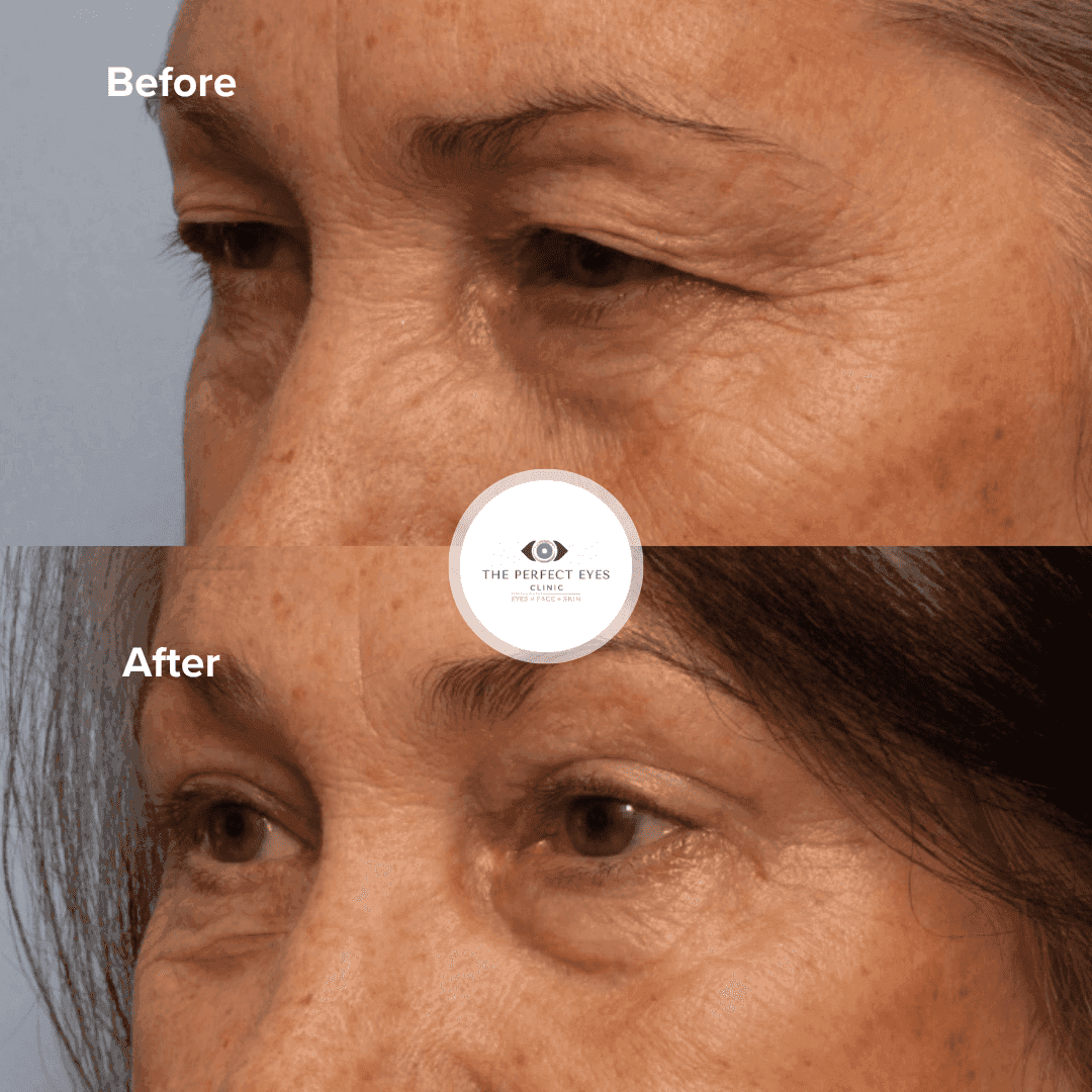 Ptosis surgery before and after, case 20, by Dr Sabrina Shah-Desai