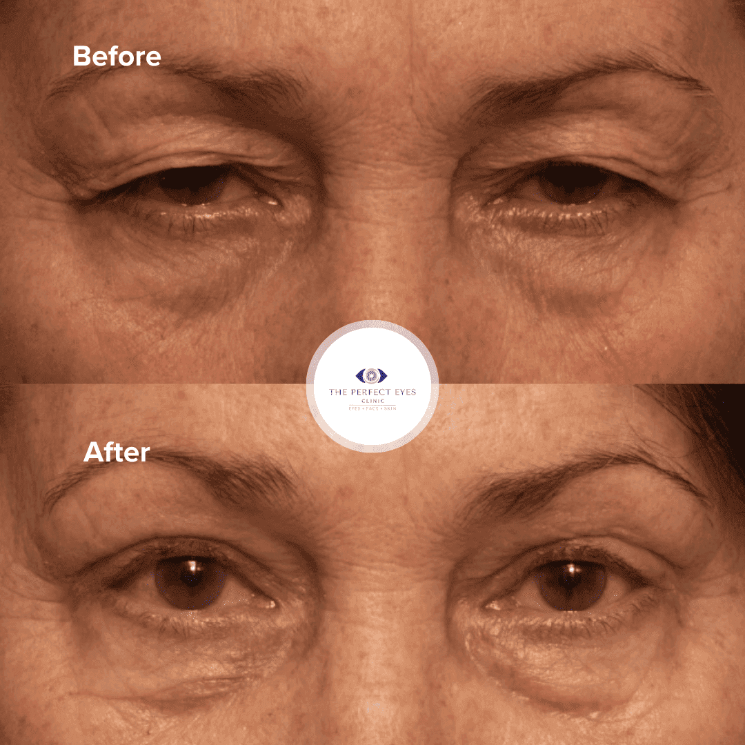 Ptosis surgery before and after, case 18, by Dr Sabrina Shah-Desai