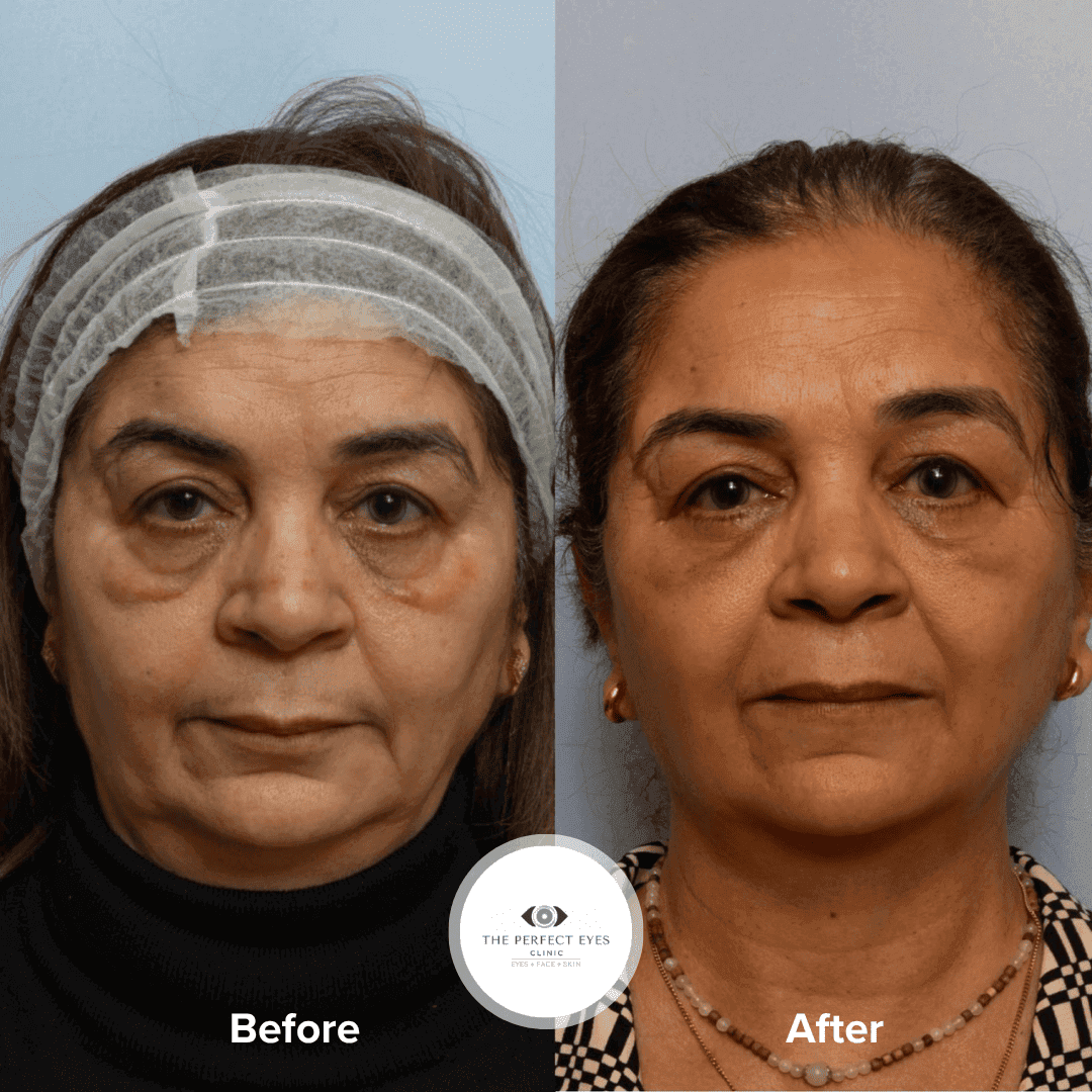 Midface Lift (Extended Blepharoplasty) before and after, a patient of Dr Sabrina Shah-Desai