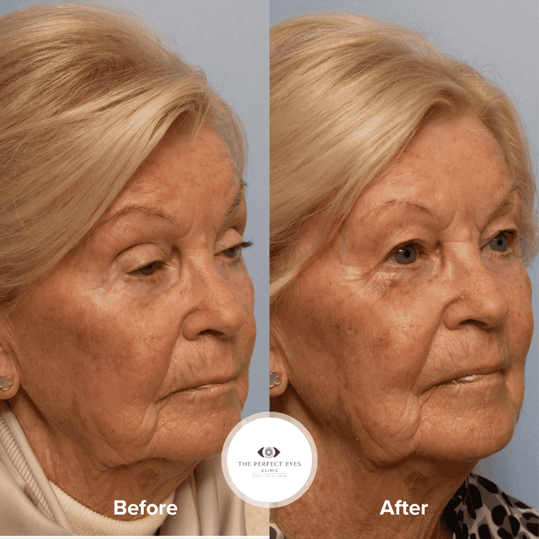 Ptosis Surgery before and after, a patient of Dr Sabrina Shah-Desai