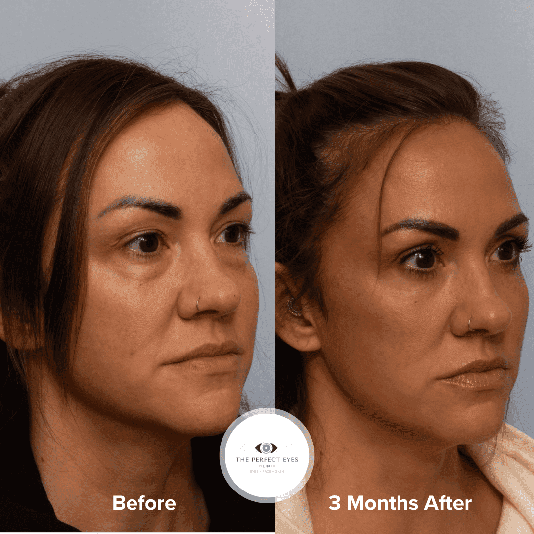 Lower blepharoplasty before and after, case 28, by Dr Sabrina Shah-Desai