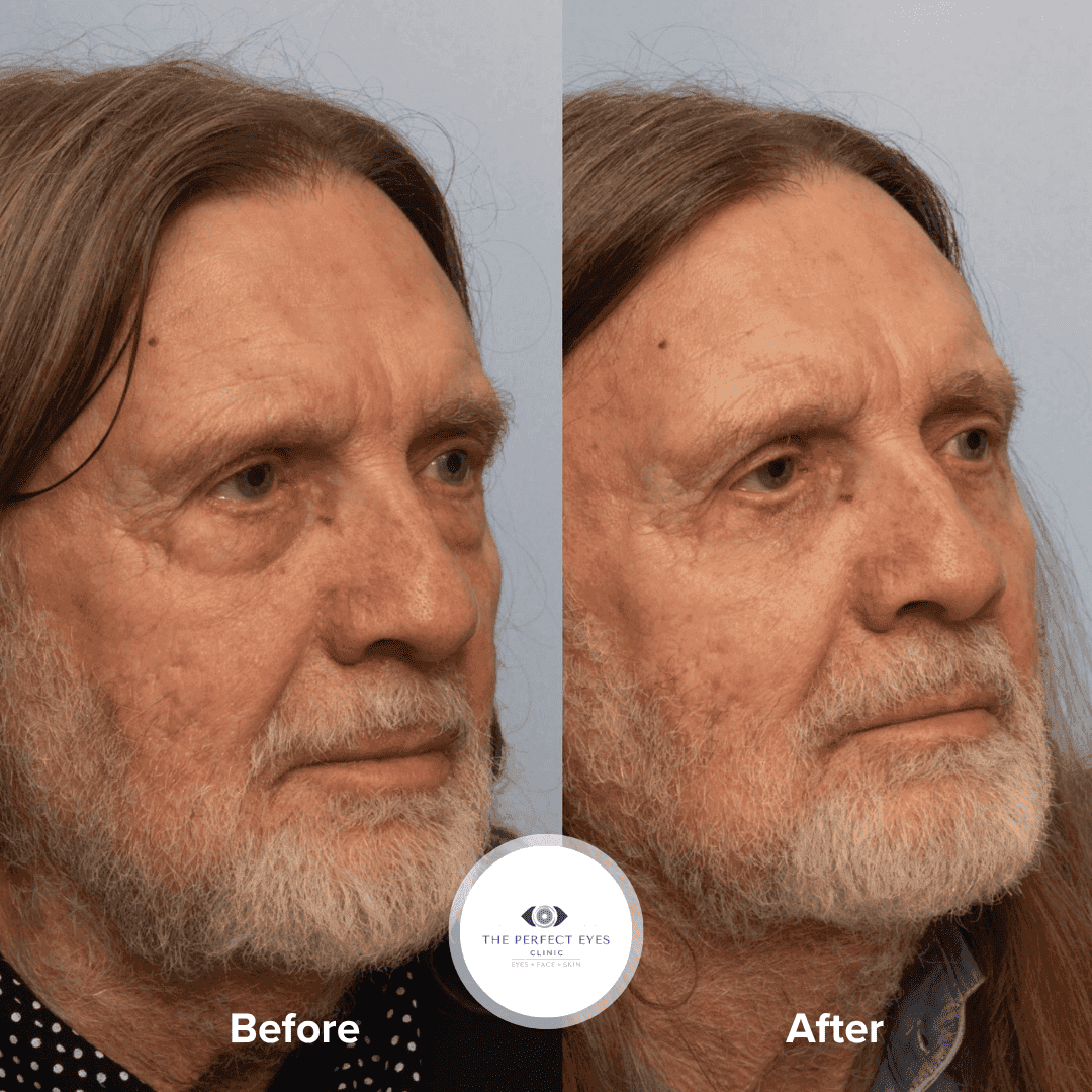 Eye Bag Surgery before and after, a patient of Dr Sabrina Shah-Desai