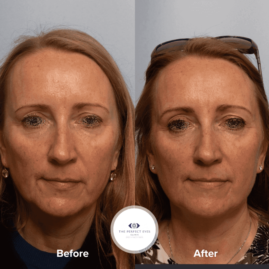 Before and after Sofwave™, a patient of Dr Sabrina Shah-Desai