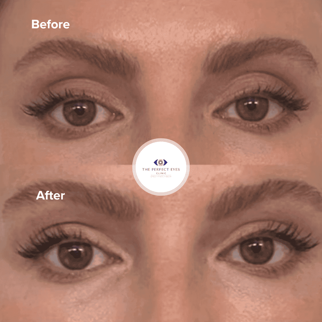 Superior Sulcus Filler before and after, a patient of Dr Sabrina Shah-Desai