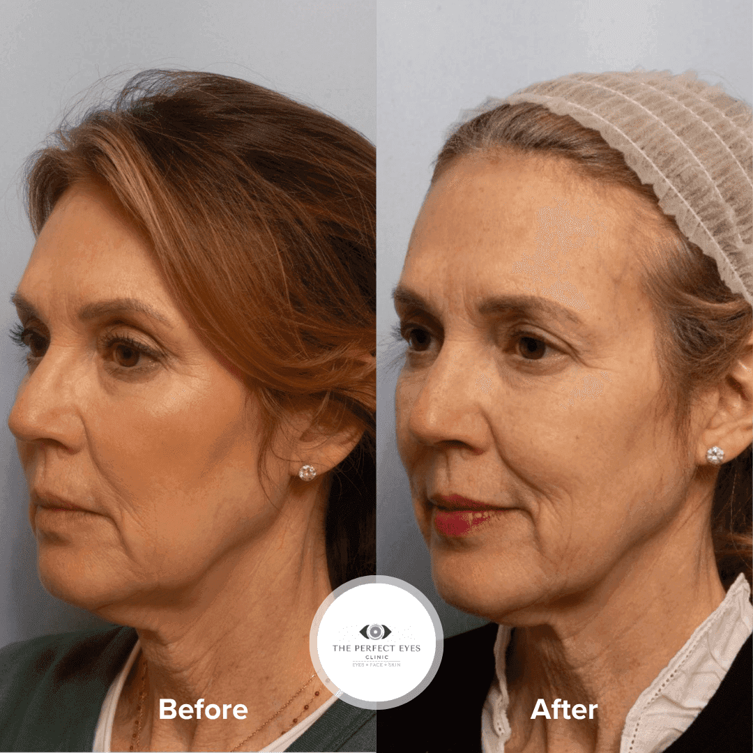 Before and after Ultraclear Lasers, a patient of Dr Sabrina Shah-Desai