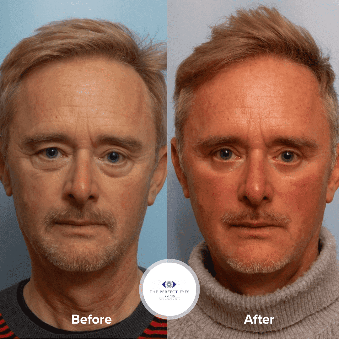 Sofwave before and after, case 4, by Dr Sabrina Shah-Desai