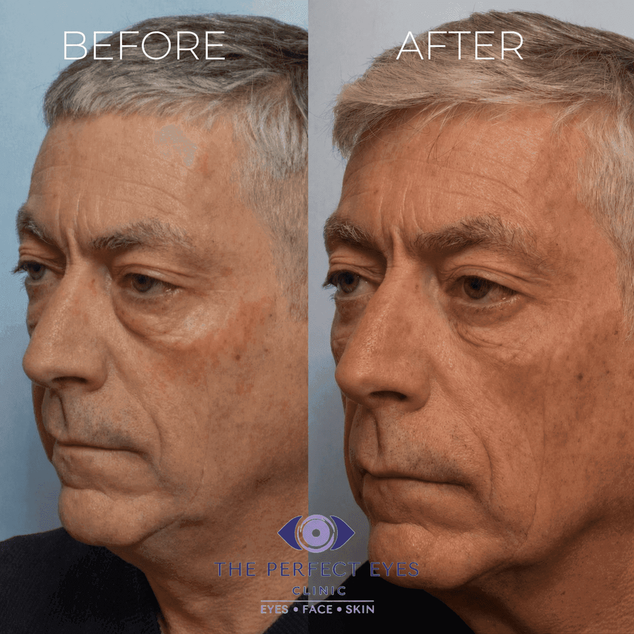 Lower blepharoplasty before and after, case 1, by Dr Sabrina Shah-Desai