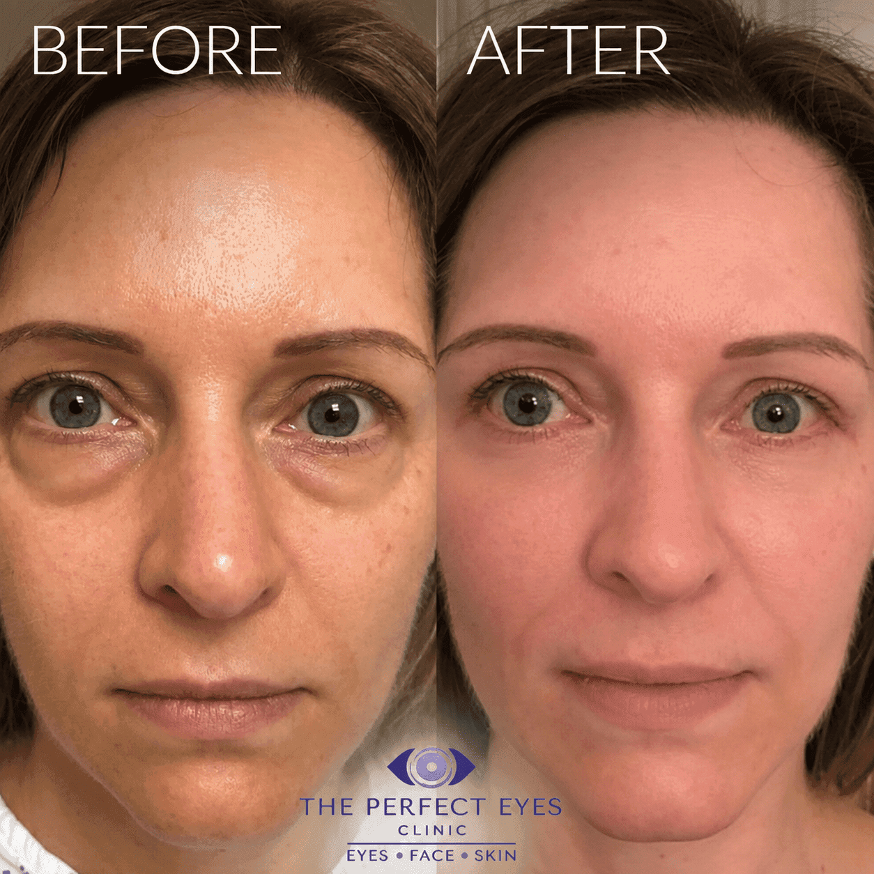 Lower blepharoplasty before and after, case 10, by Dr Sabrina Shah-Desai