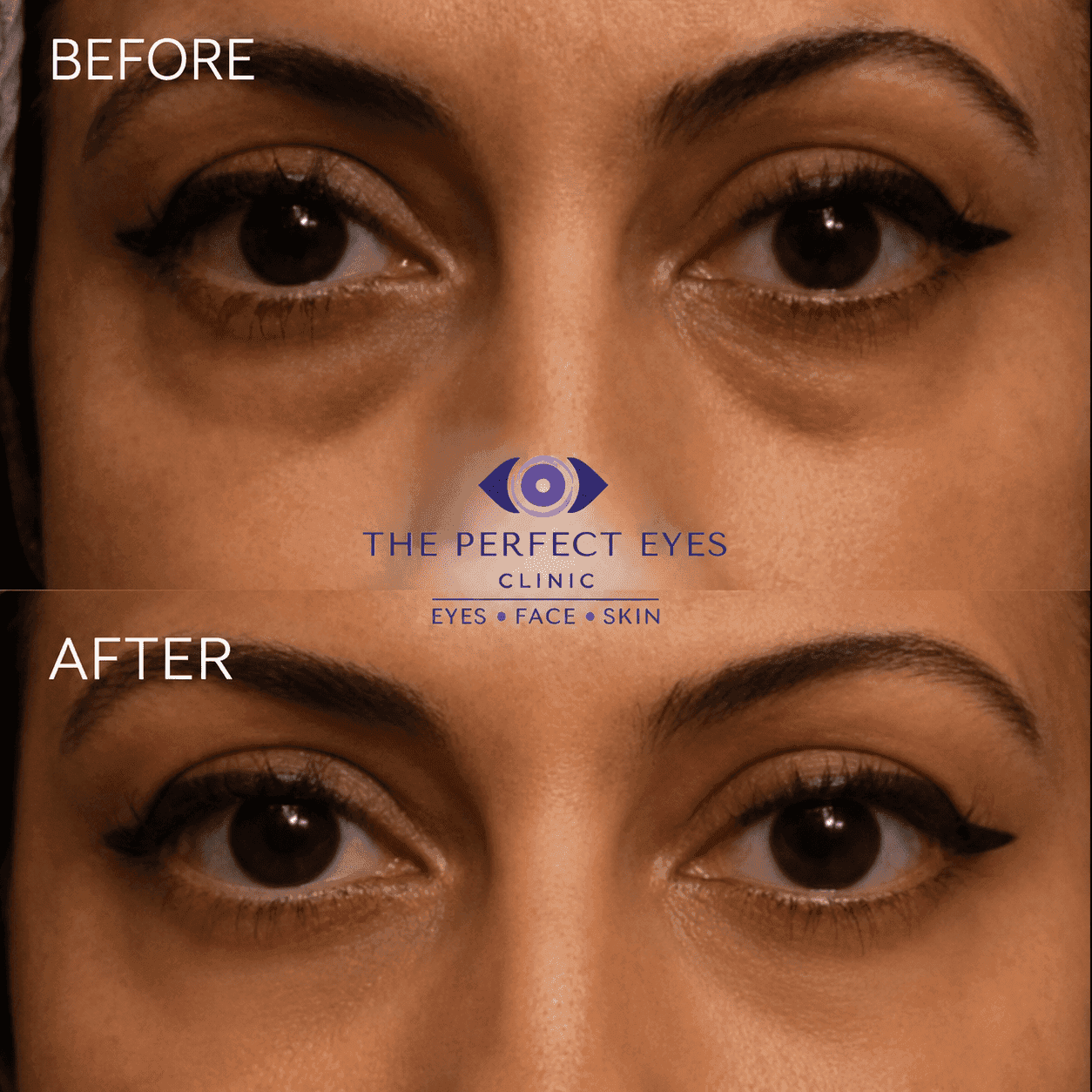 Lower blepharoplasty before and after, case 11, by Dr Sabrina Shah-Desai
