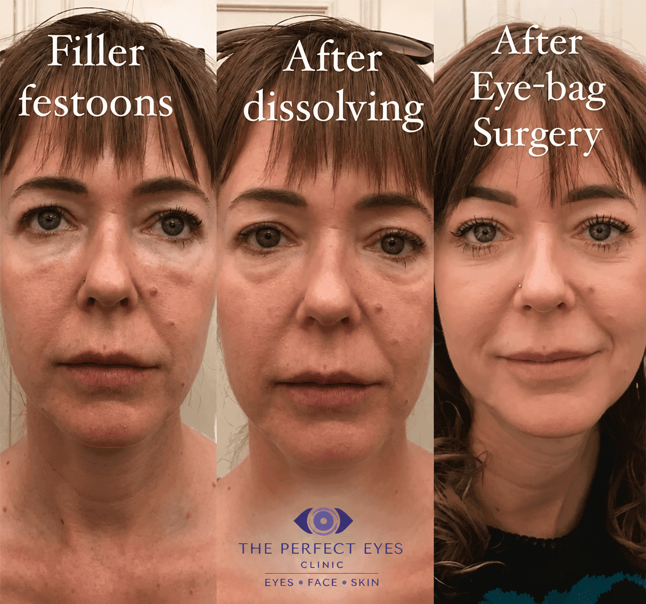 Lower blepharoplasty before and after, case 12, by Dr Sabrina Shah-Desai