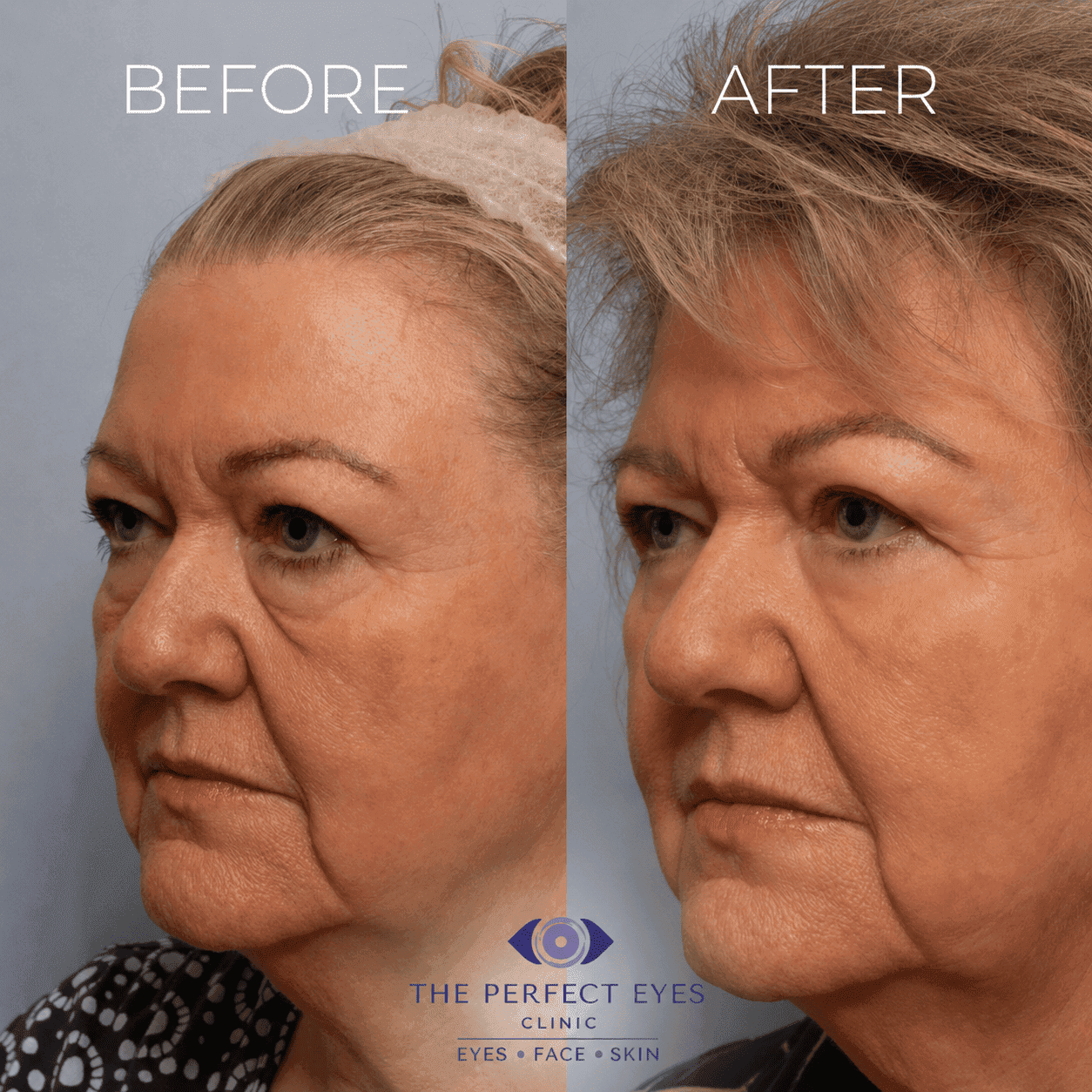 Lower blepharoplasty before and after, case 13, by Dr Sabrina Shah-Desai