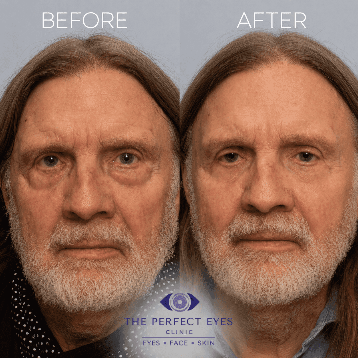 Lower blepharoplasty before and after, case 15, by Dr Sabrina Shah-Desai