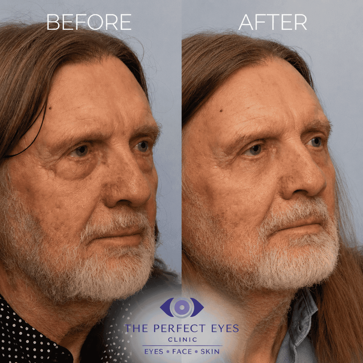Lower blepharoplasty before and after, case 16, by Dr Sabrina Shah-Desai