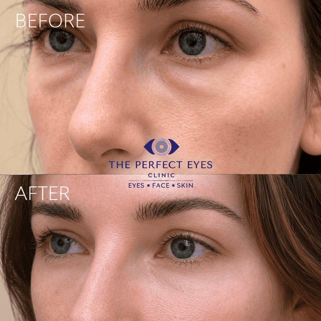 Lower blepharoplasty before and after, case 17, by Dr Sabrina Shah-Desai