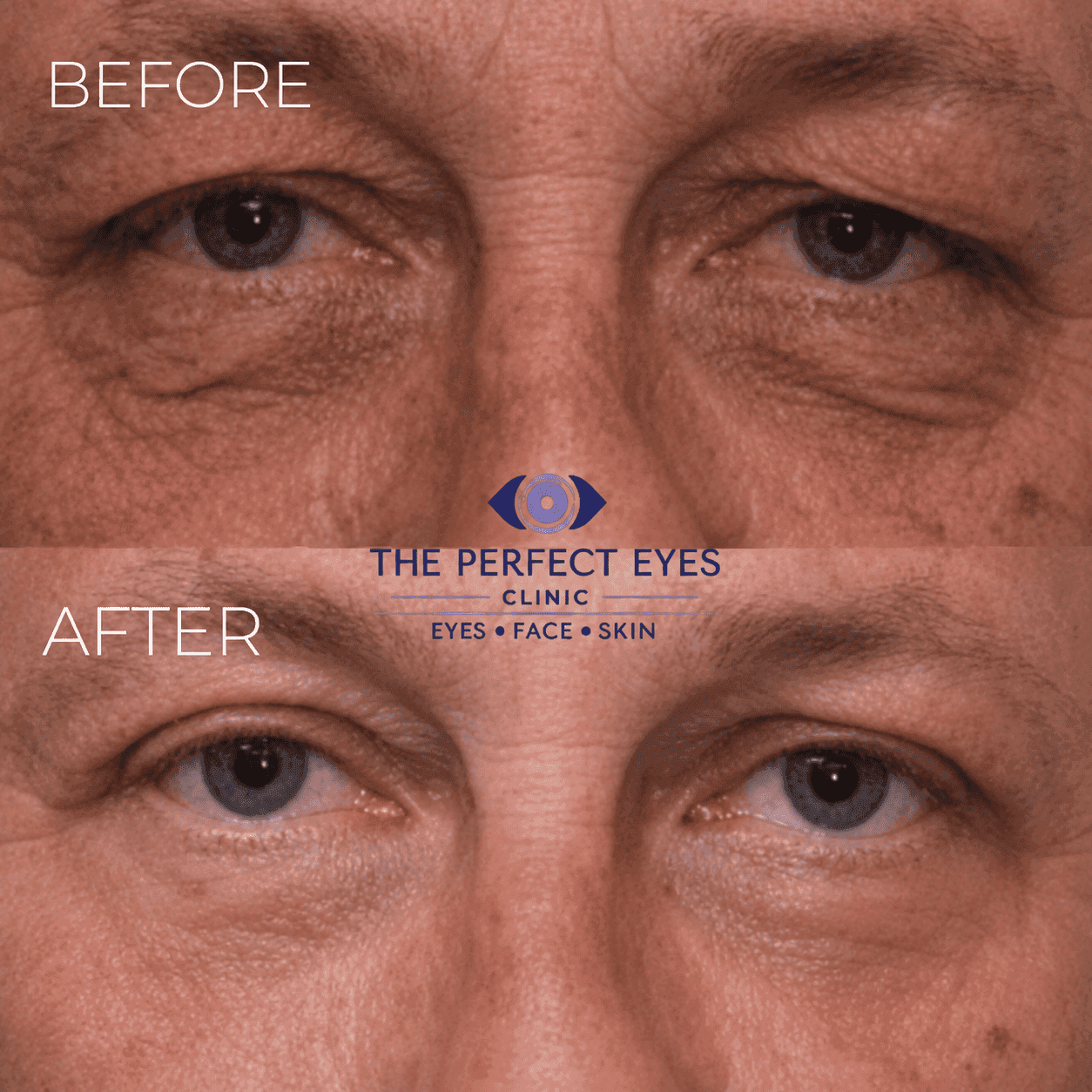 Lower blepharoplasty before and after, case 19, by Dr Sabrina Shah-Desai
