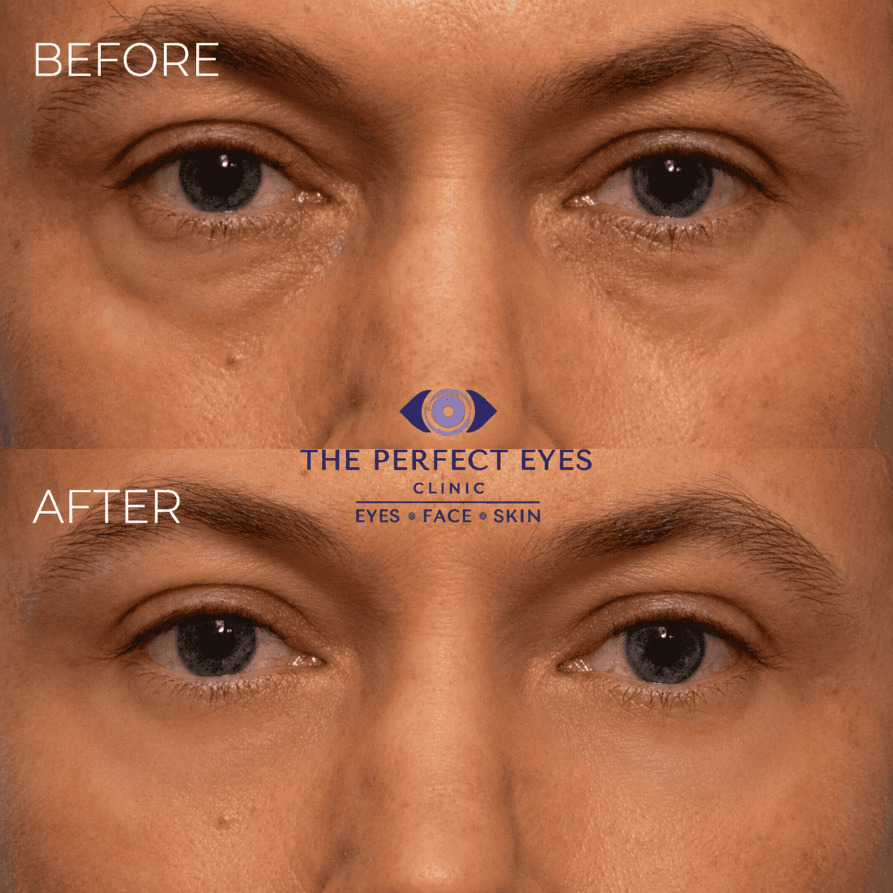 Lower blepharoplasty before and after, case 20, by Dr Sabrina Shah-Desai