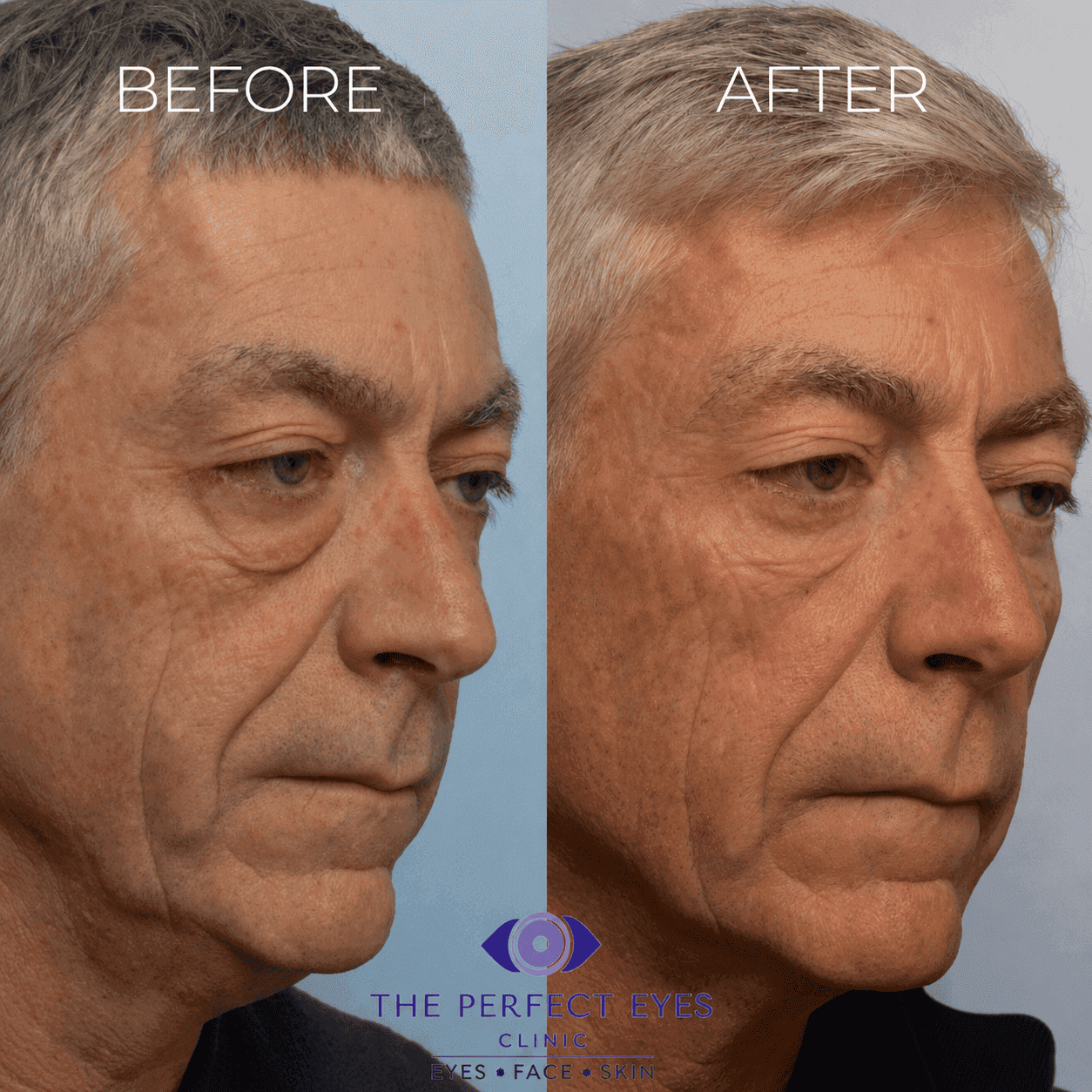 Lower blepharoplasty before and after, case 21, by Dr Sabrina Shah-Desai