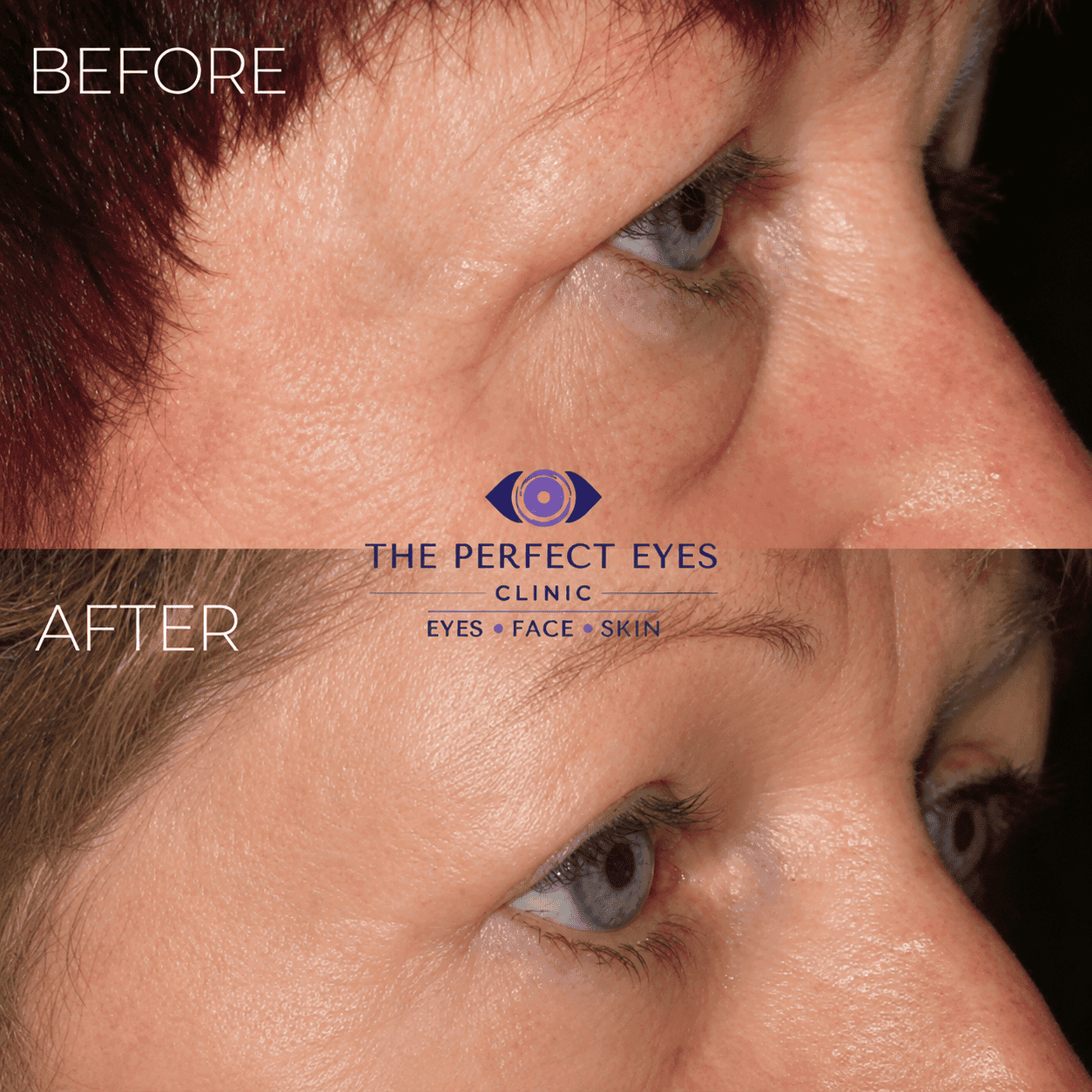 Lower blepharoplasty before and after, case 22, by Dr Sabrina Shah-Desai