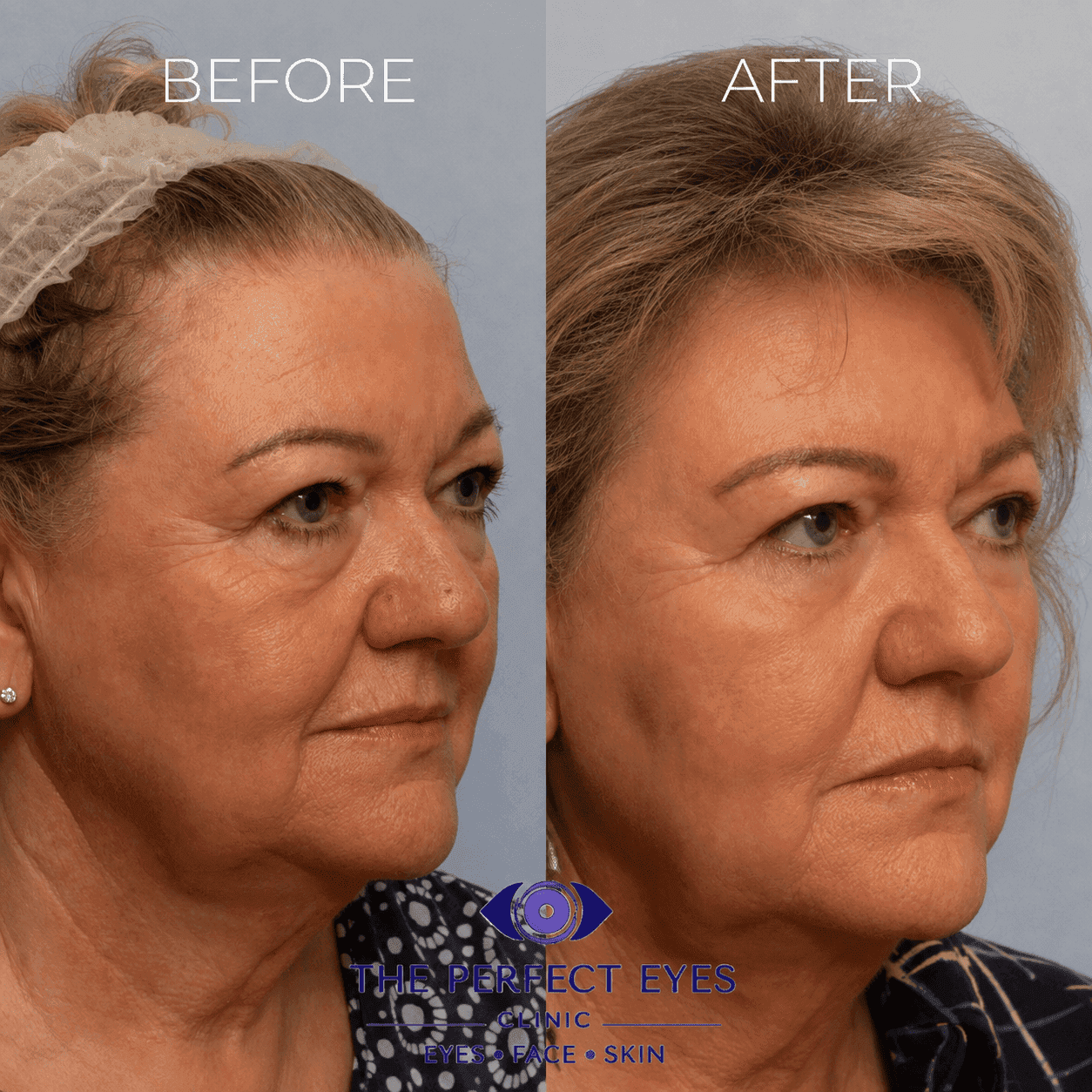 Lower blepharoplasty before and after, case 24, by Dr Sabrina Shah-Desai