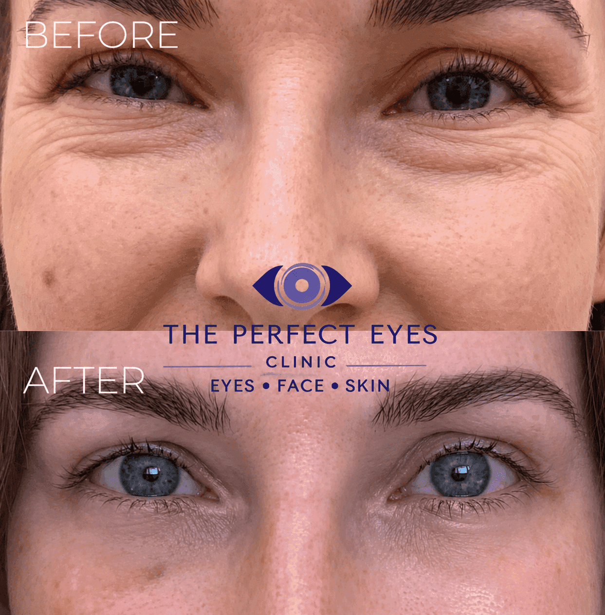 Lower blepharoplasty before and after, case 25, by Dr Sabrina Shah-Desai