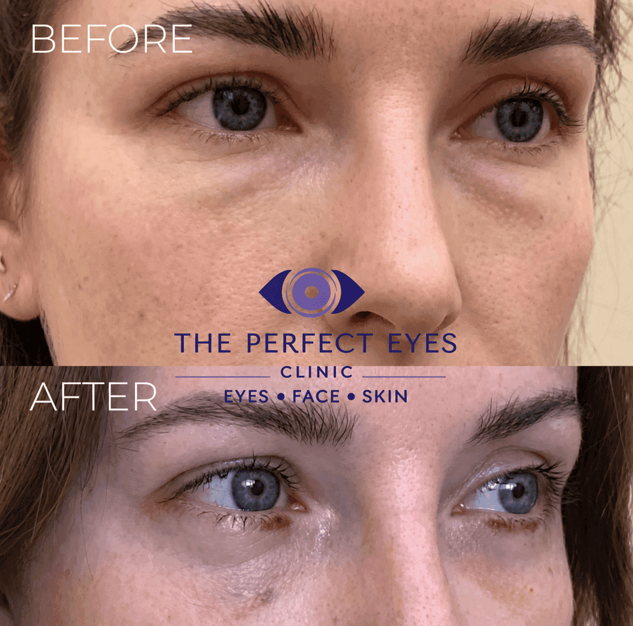 Lower blepharoplasty before and after, case 26, by Dr Sabrina Shah-Desai