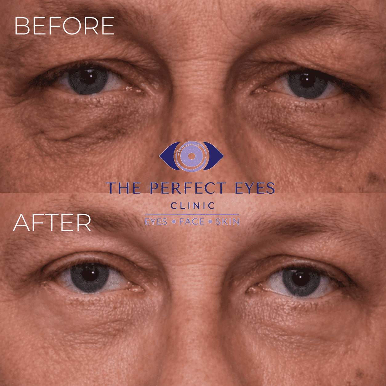 Lower blepharoplasty before and after, case 3, by Dr Sabrina Shah-Desai