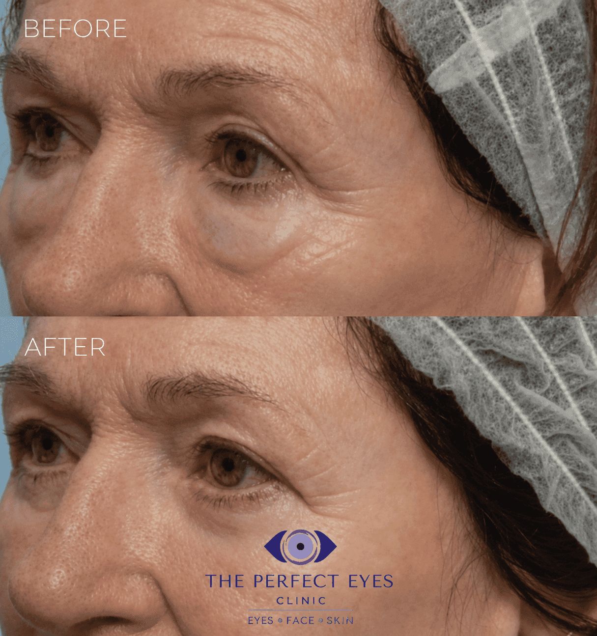 Lower blepharoplasty before and after, case 4, by Dr Sabrina Shah-Desai