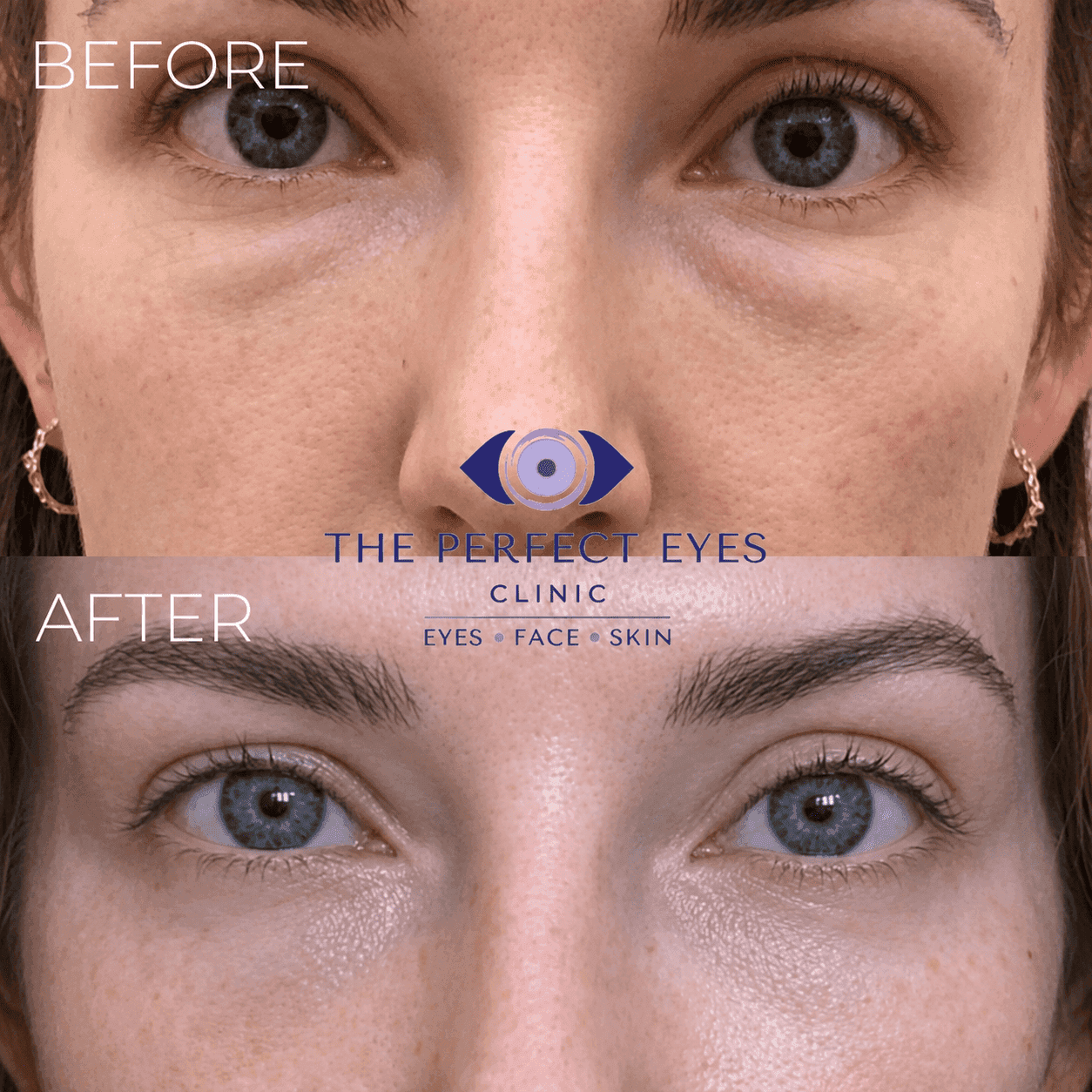 Lower blepharoplasty before and after, case 5, by Dr Sabrina Shah-Desai