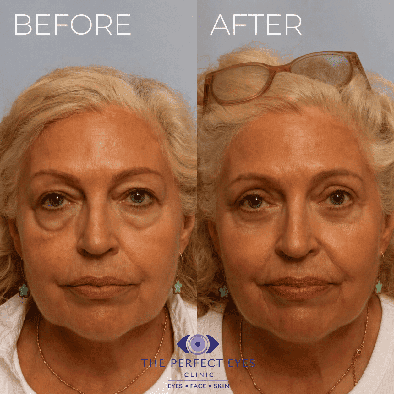 Lower blepharoplasty before and after, case 6, by Dr Sabrina Shah-Desai