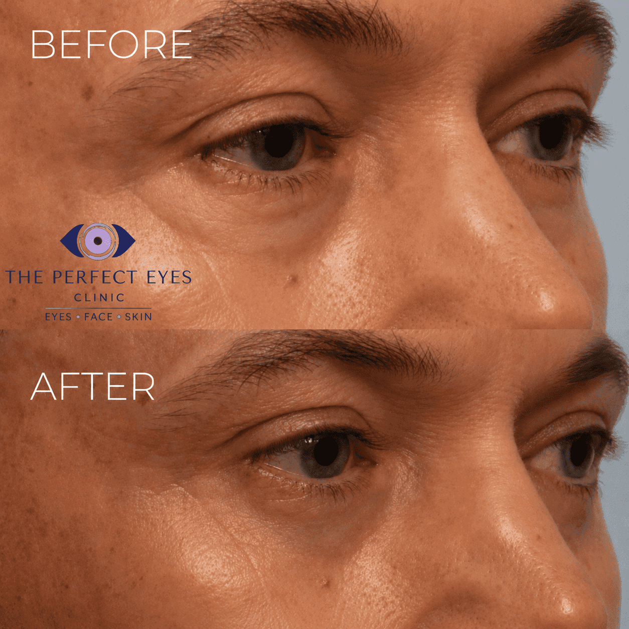 Lower blepharoplasty before and after, case 7, by Dr Sabrina Shah-Desai