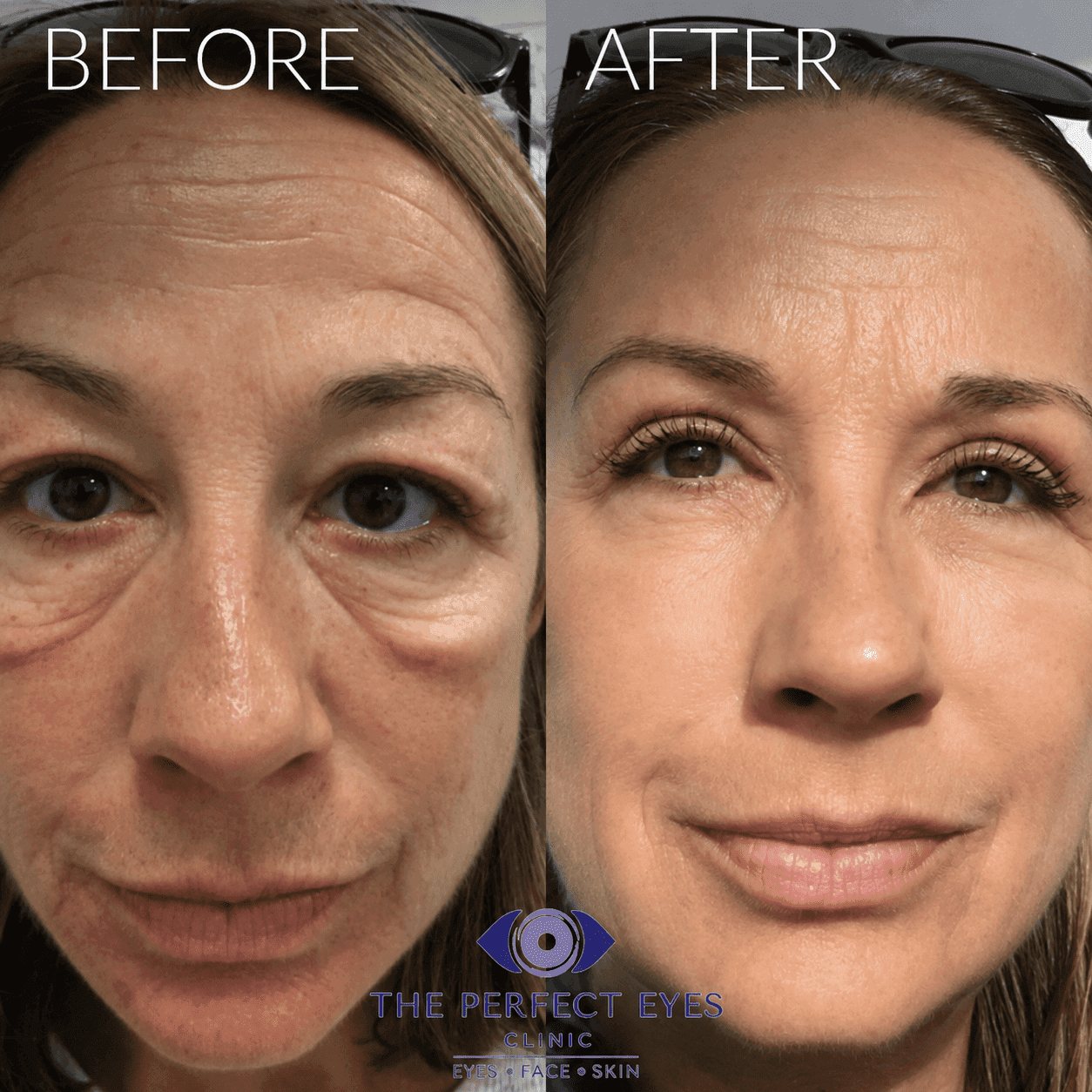 Lower lid blepharoplasty before and after