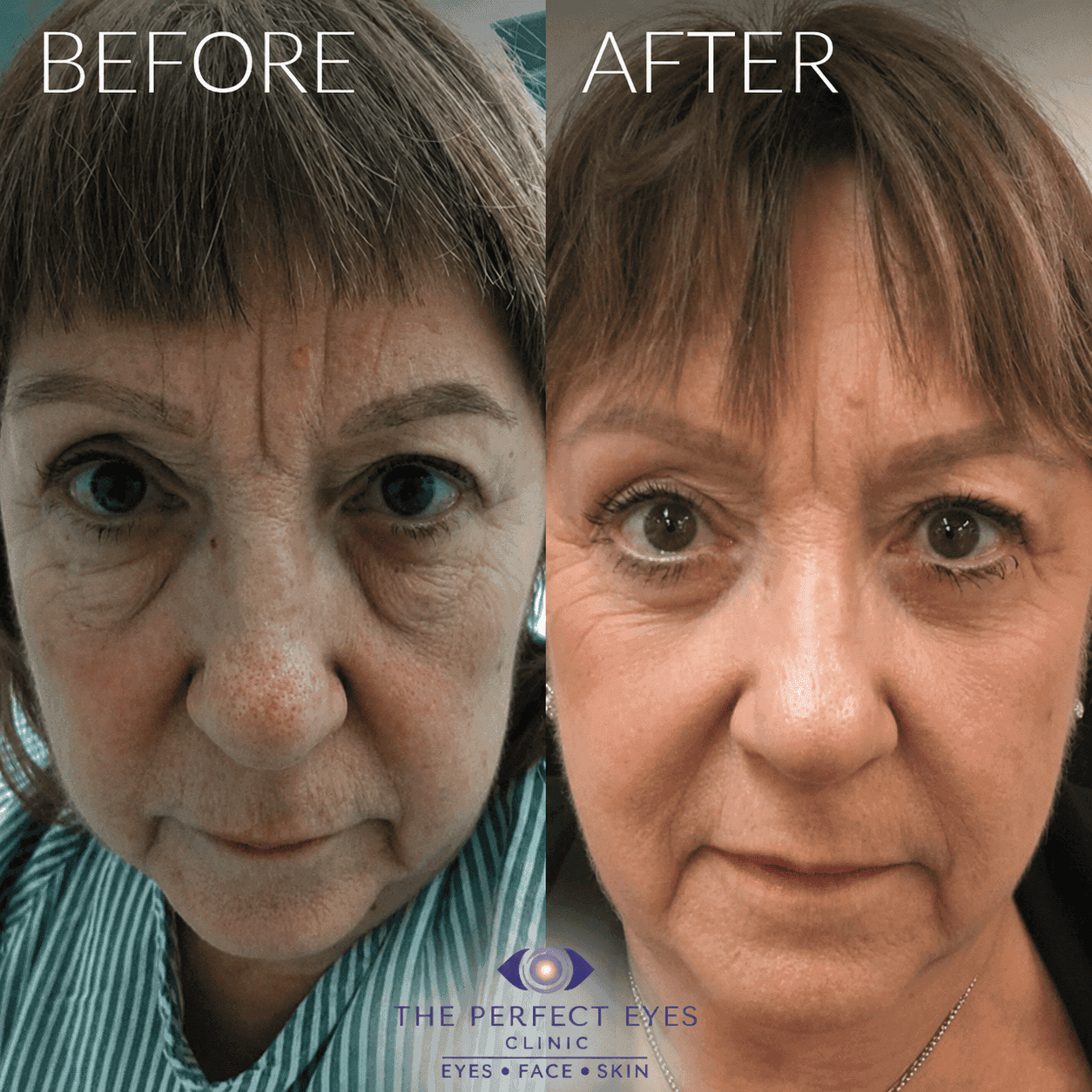 Lower blepharoplasty before and after, case 9, by Dr Sabrina Shah-Desai