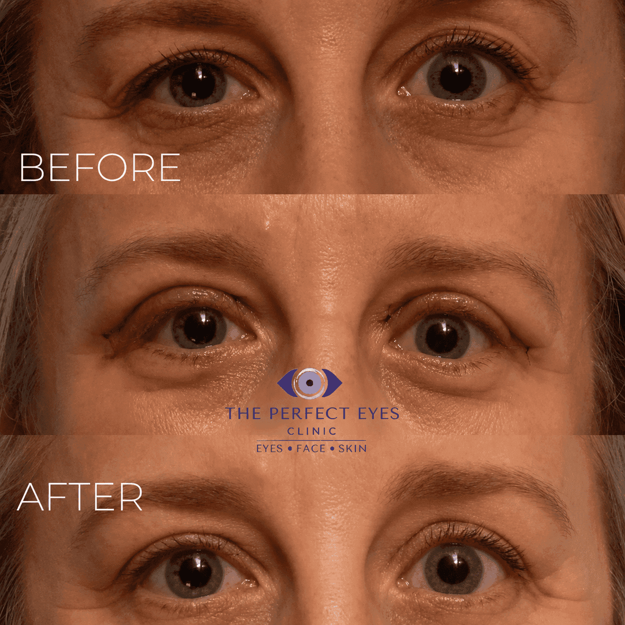 Ptosis surgery before and after, case 1, by Dr Sabrina Shah-Desai