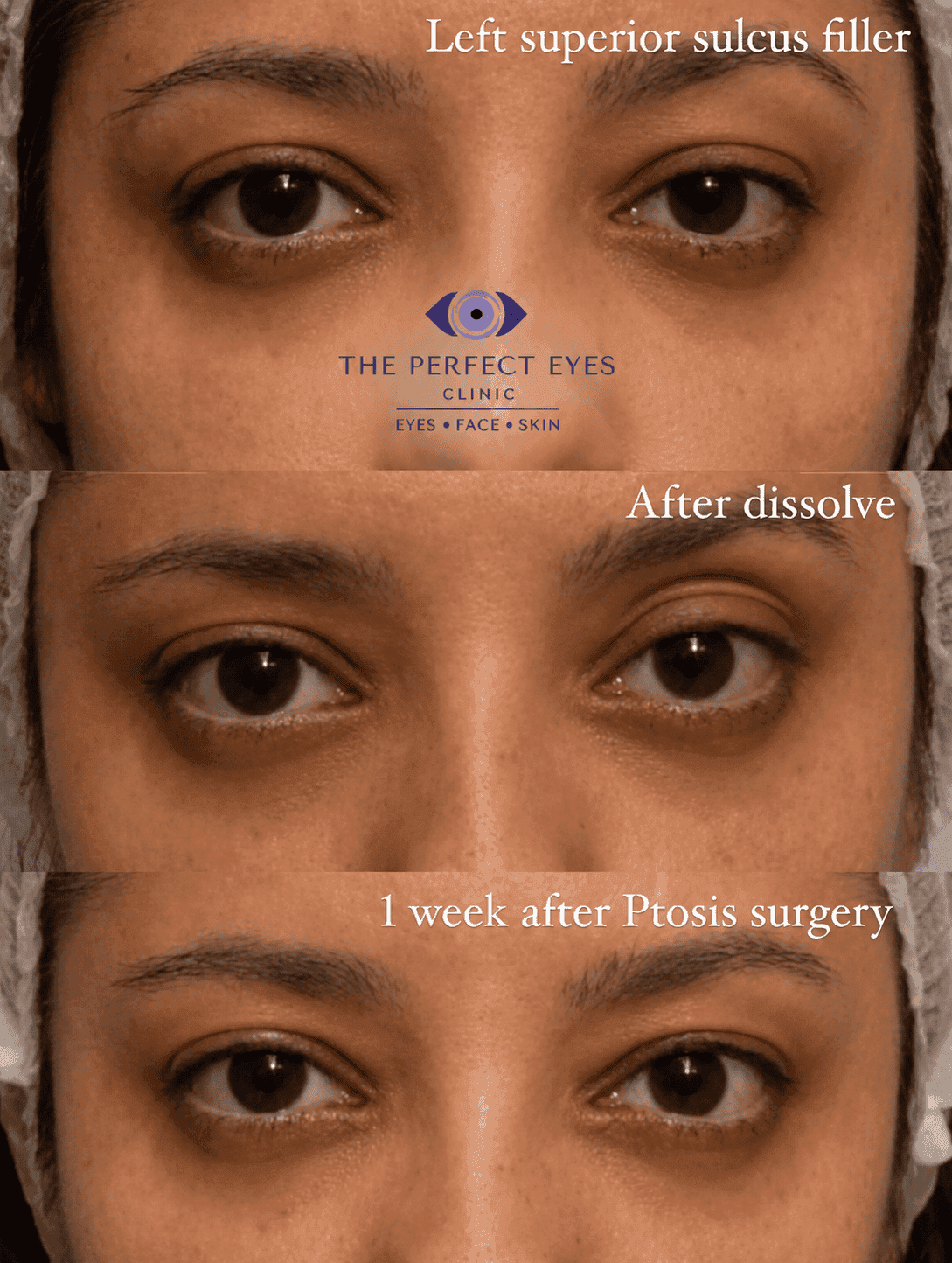 Ptosis surgery before and after, case 11, by Dr Sabrina Shah-Desai