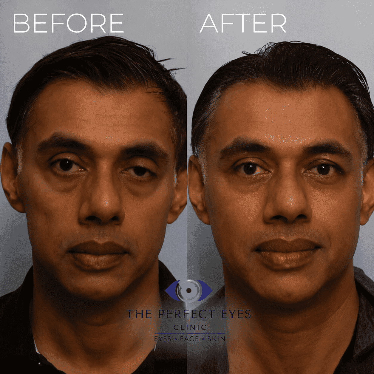 Ptosis surgery before and after, case 12, by Dr Sabrina Shah-Desai