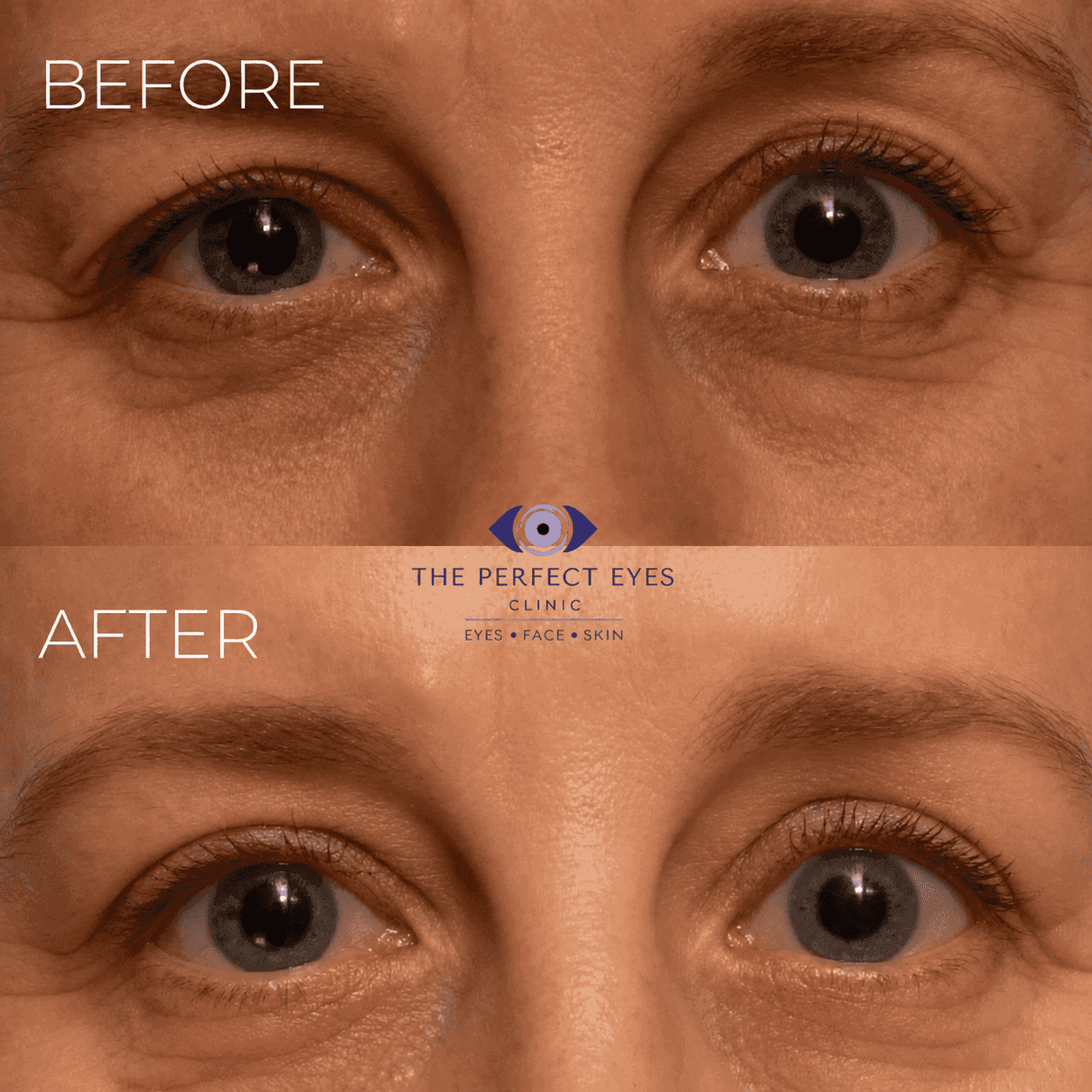 Ptosis surgery before and after, case 13, by Dr Sabrina Shah-Desai
