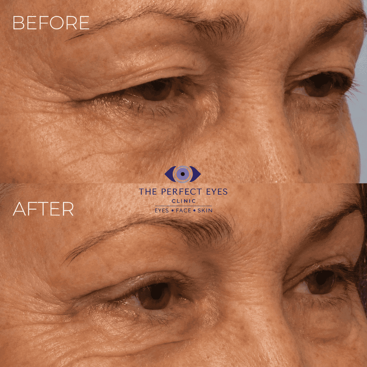 Ptosis surgery before and after, case 14, by Dr Sabrina Shah-Desai