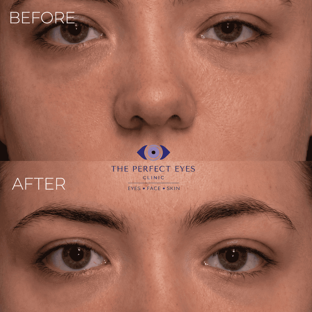 Ptosis surgery before and after, case 15, by Dr Sabrina Shah-Desai