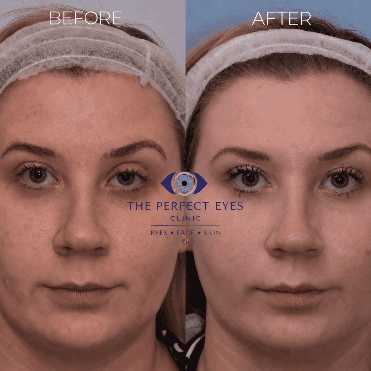 Ptosis surgery before and after, case 16, by Dr Sabrina Shah-Desai