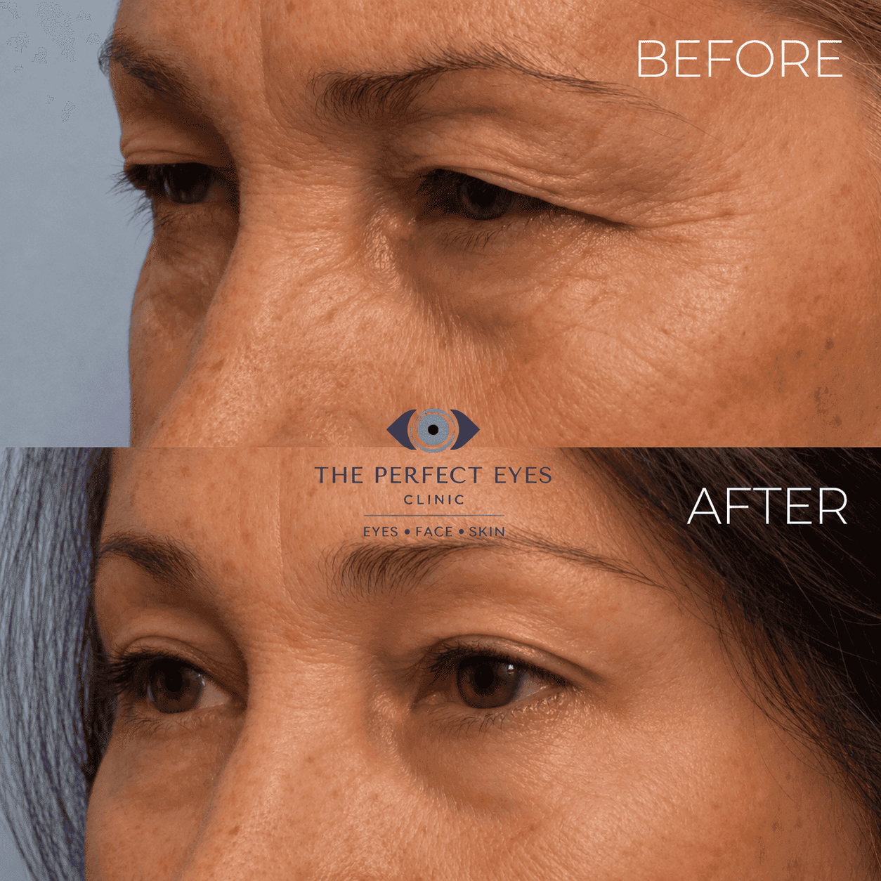 Ptosis surgery before and after, case 18, by Dr Sabrina Shah-Desai