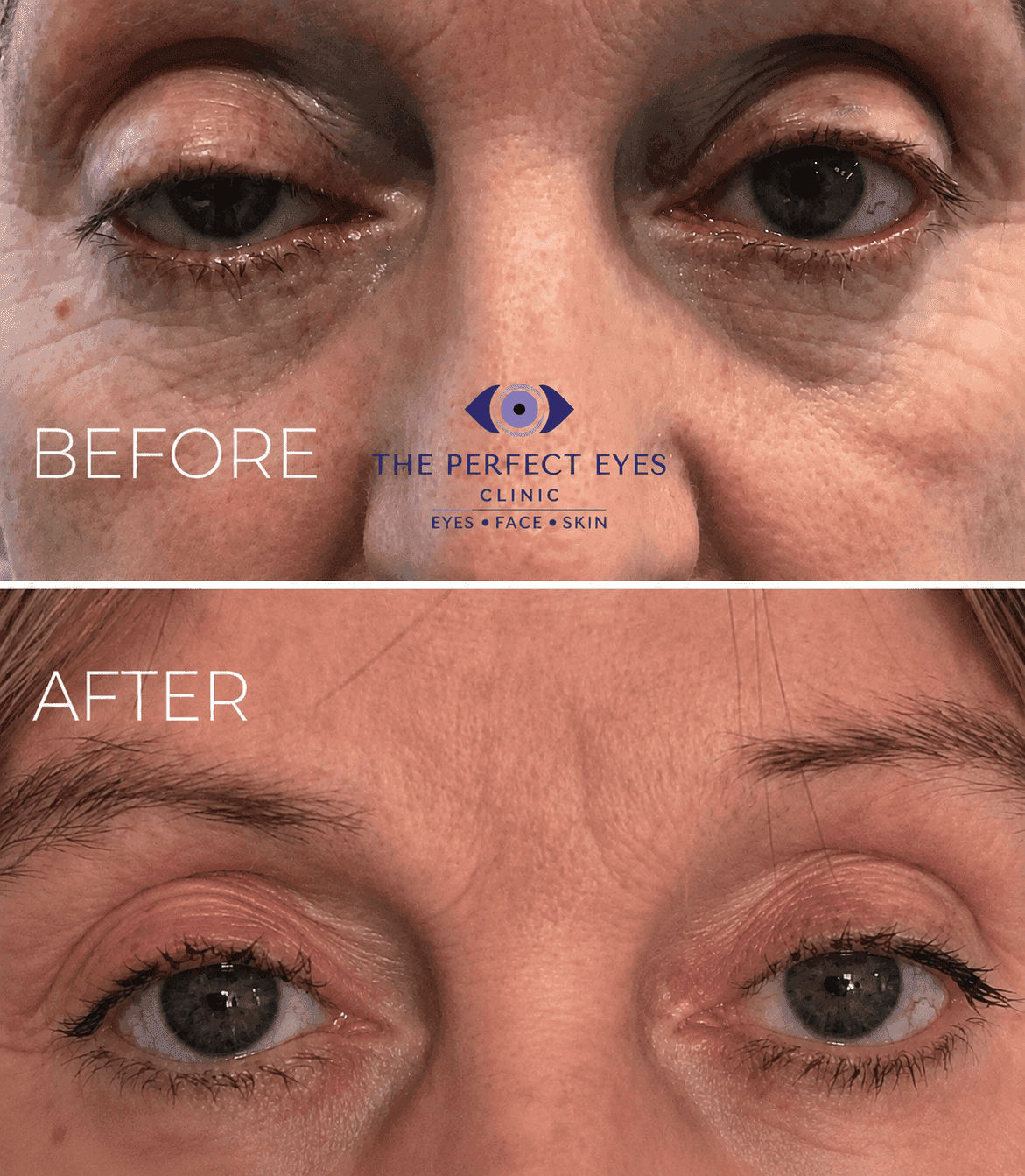 Ptosis surgery before and after, case 2, by Dr Sabrina Shah-Desai