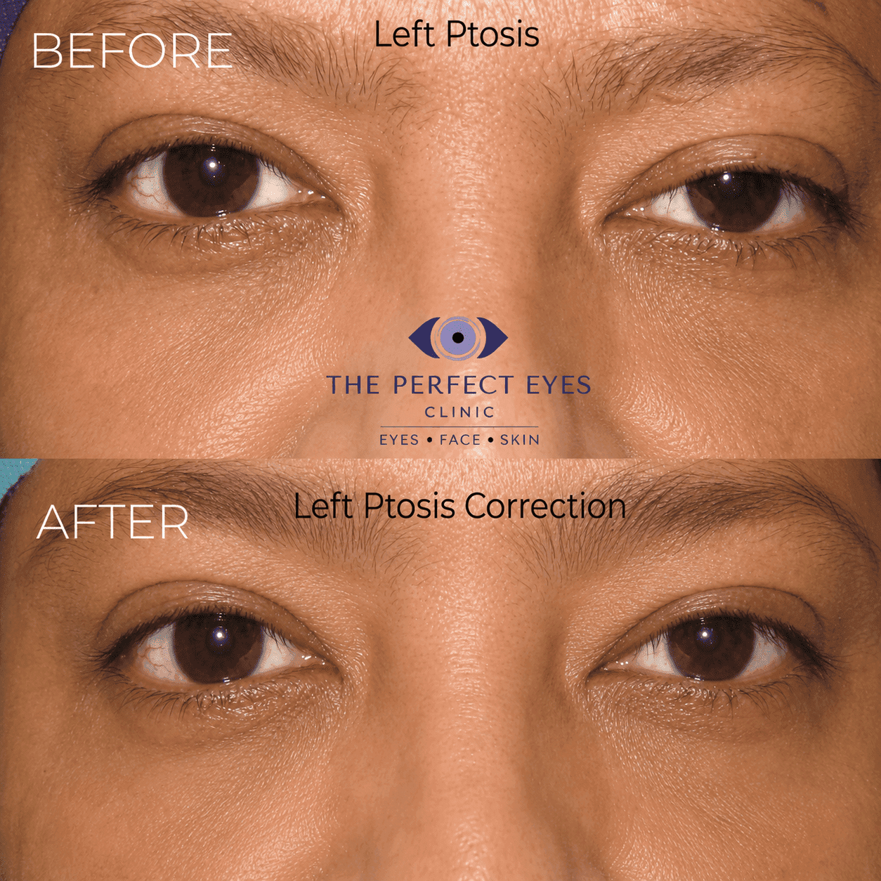 Ptosis surgery before and after, case 3, by Dr Sabrina Shah-Desai