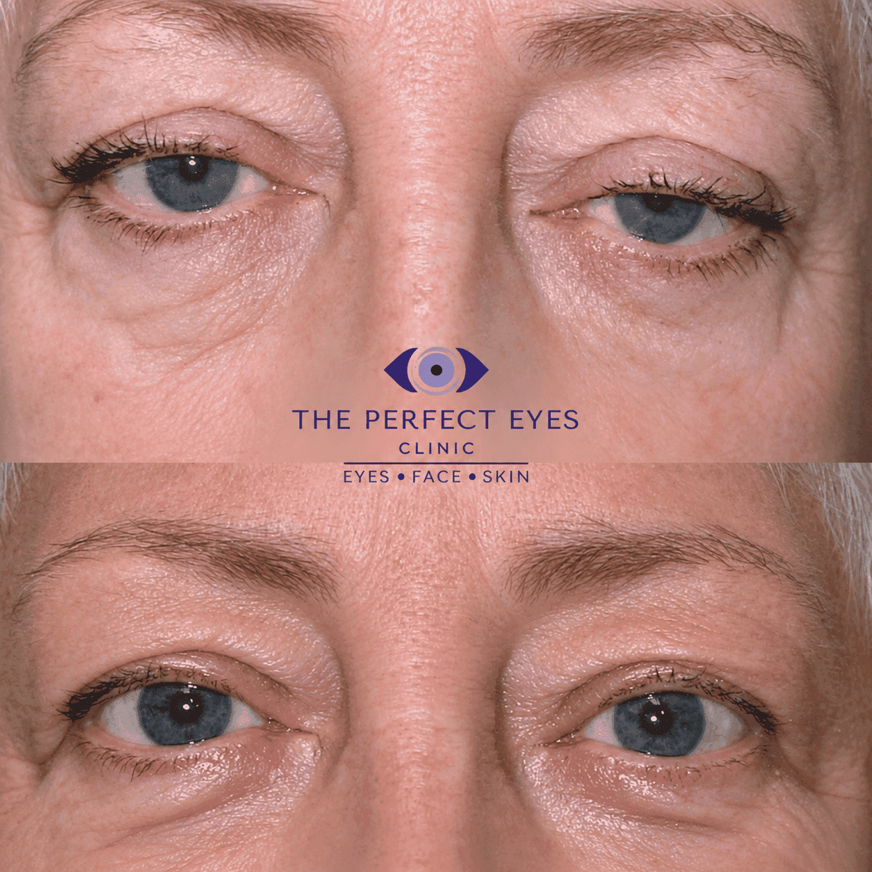 Ptosis surgery before and after, case 4, by Dr Sabrina Shah-Desai