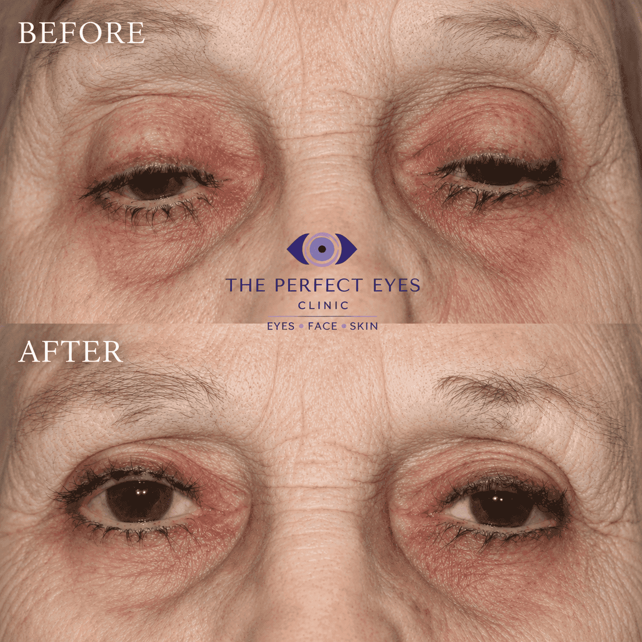 Ptosis surgery before and after, case 5, by Dr Sabrina Shah-Desai